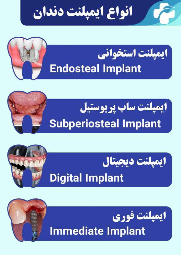 خدمات ایمپلنت دندان - مرکز ایمپلنت دکتر روشن طلب