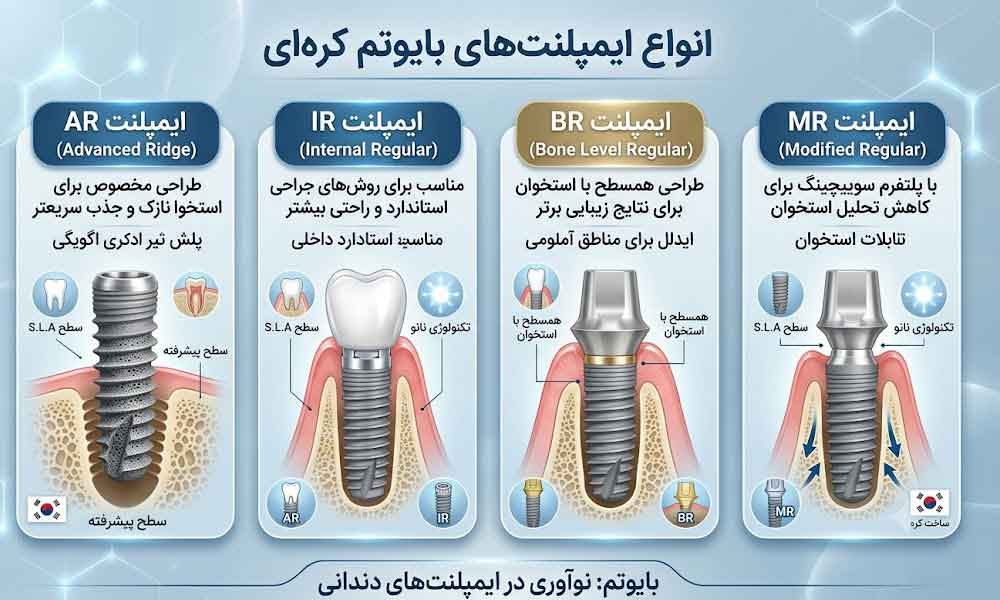 ایمپلنت بایوتم