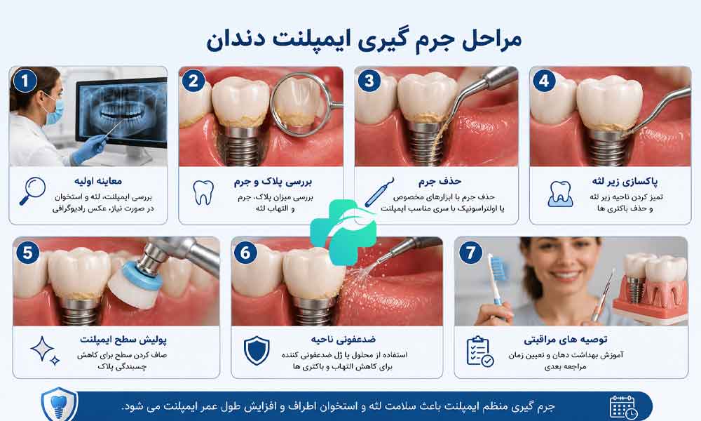 جرم گیری ایمپلنت دندان