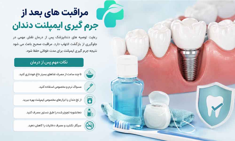 جرم گیری ایمپلنت دندان