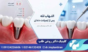 التهاب لثه بعد از ایمپلنت
