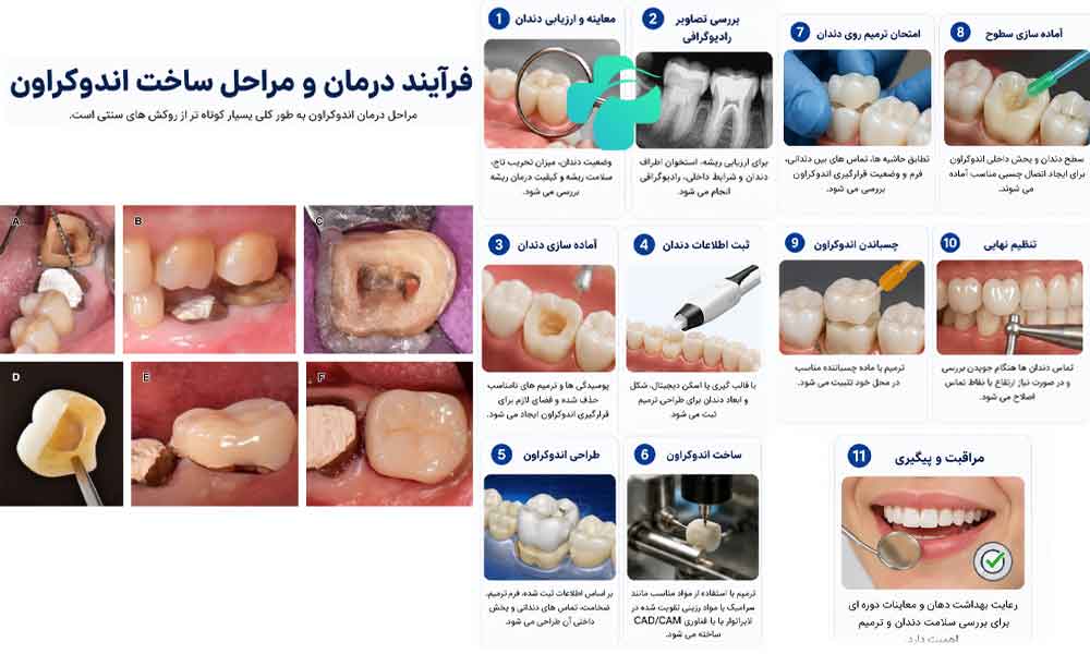اندوکراون چیست