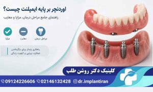 اوردنچر بر پایه ایمپلنت