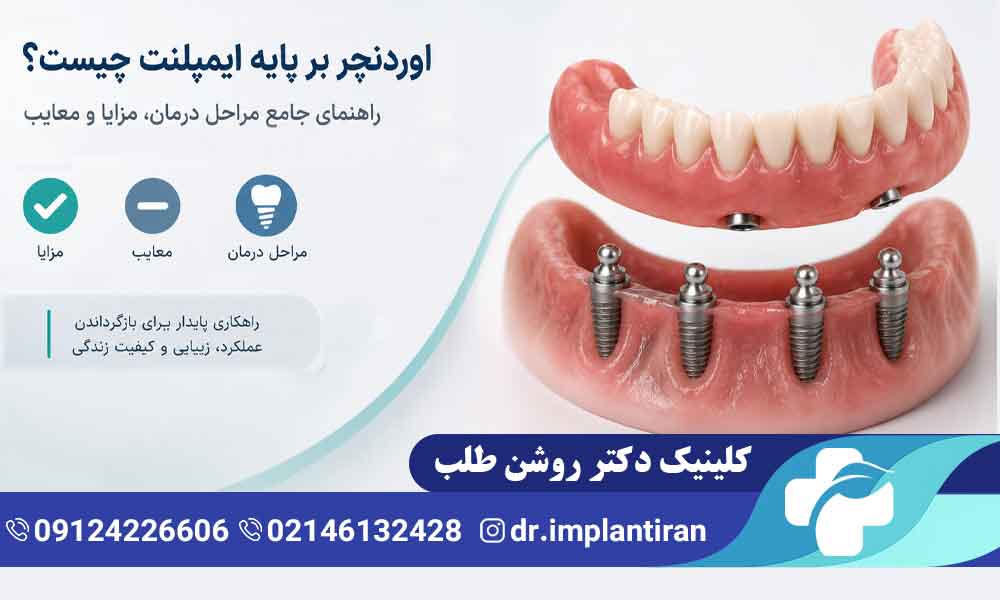 اوردنچر بر پایه ایمپلنت