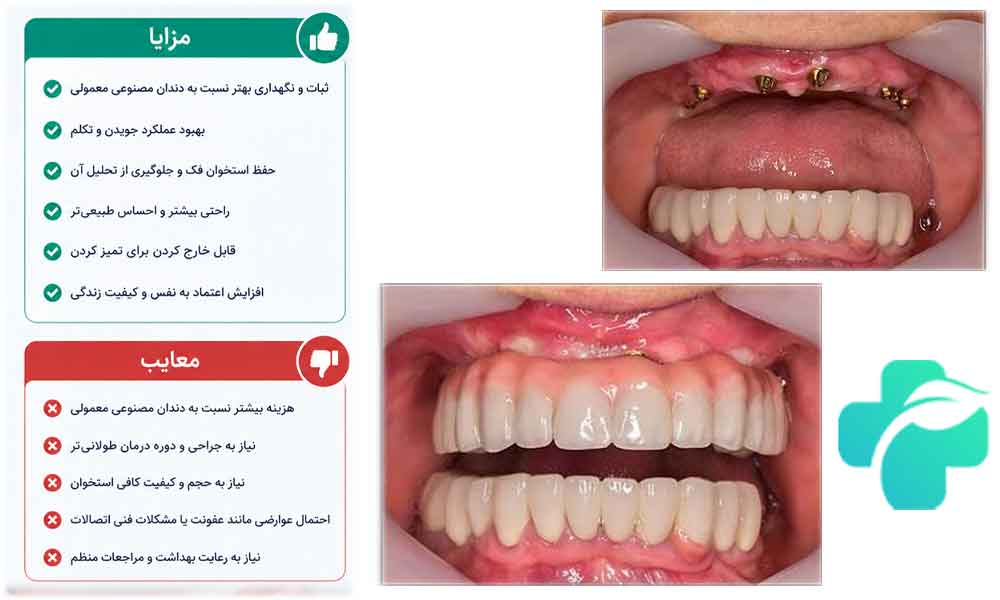 اوردنچر بر پایه ایمپلنت