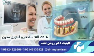 ایمپلنت All-on-4