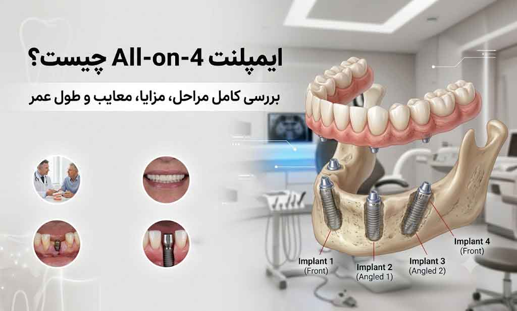 ایمپلنت All-on-4