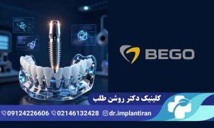 ایمپلنت Bego چیست