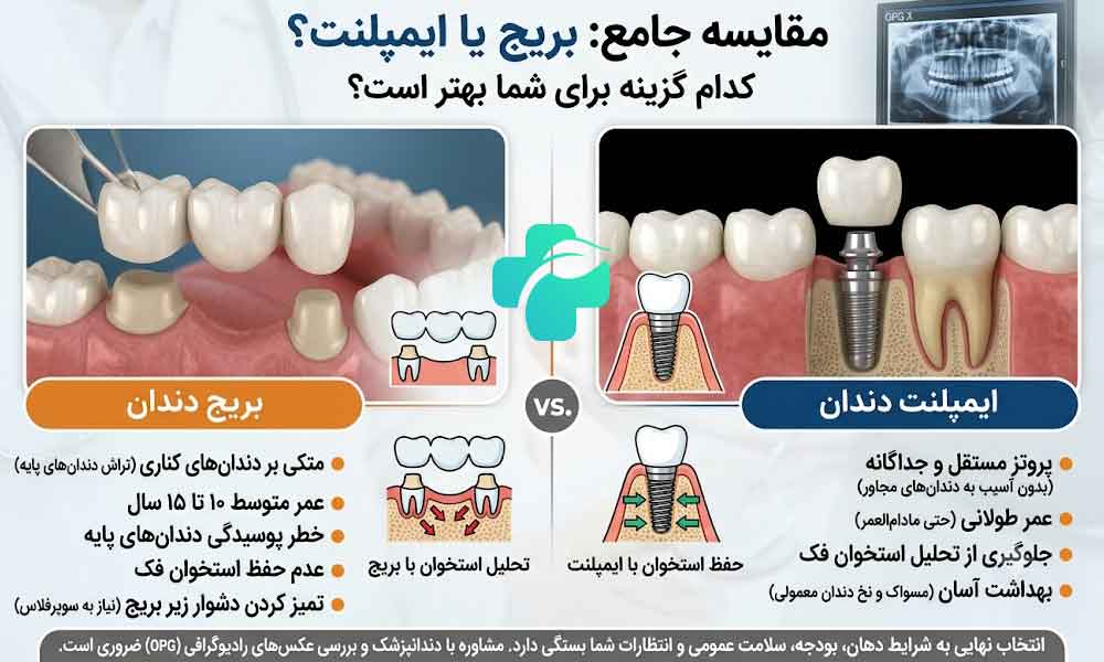 بریج یا ایمپلنت