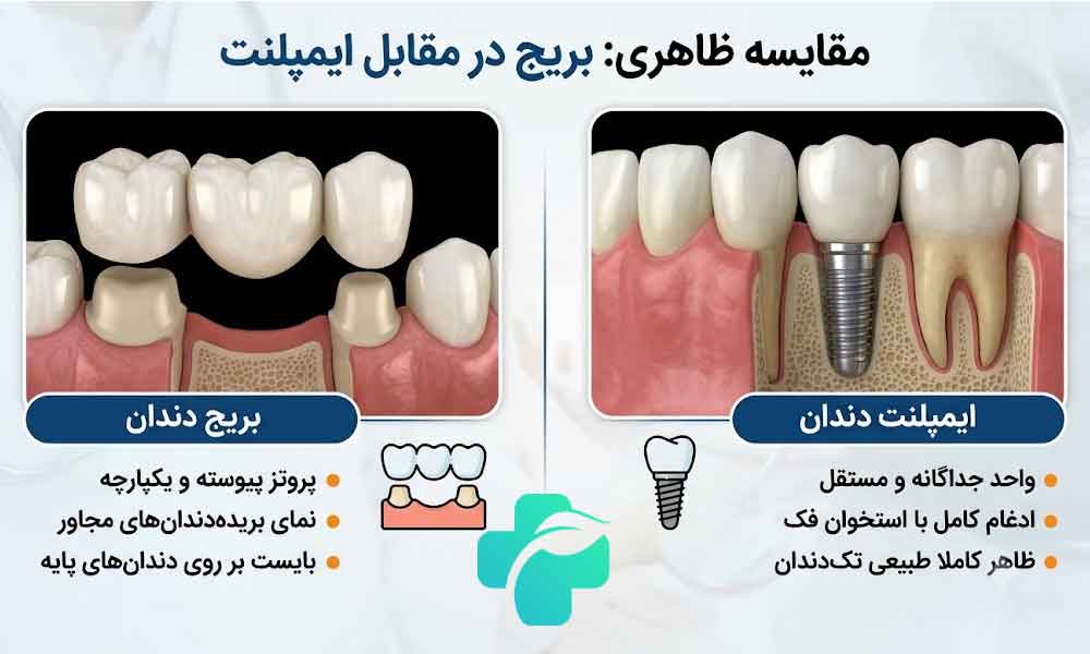 بریج یا ایمپلنت