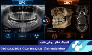 تفاوت عکس opg و cbct