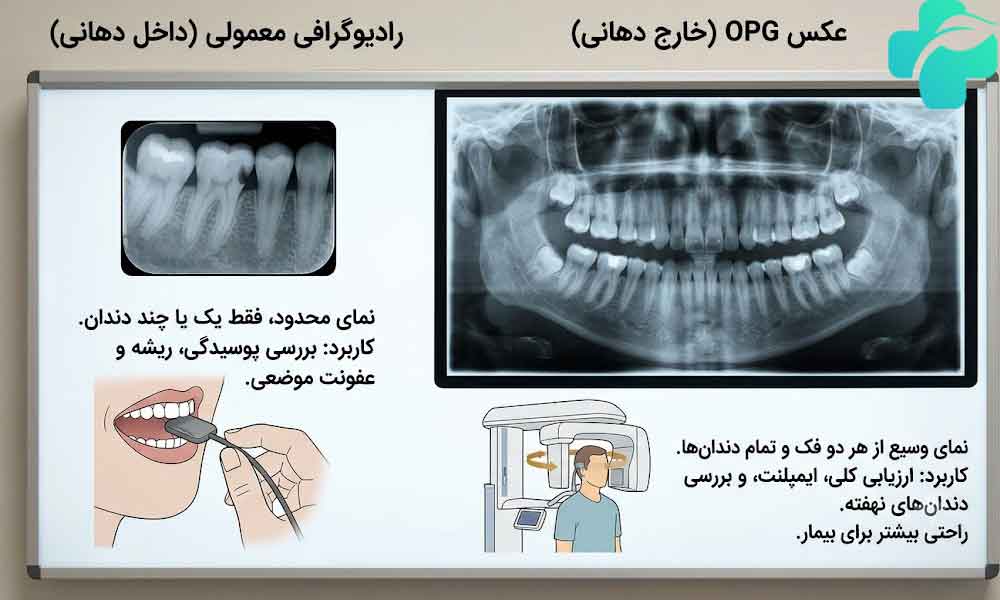 عکس OPG دندان چیست؟