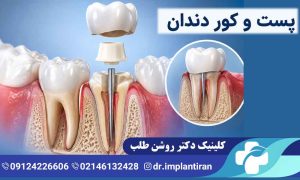 پست دندان چیست