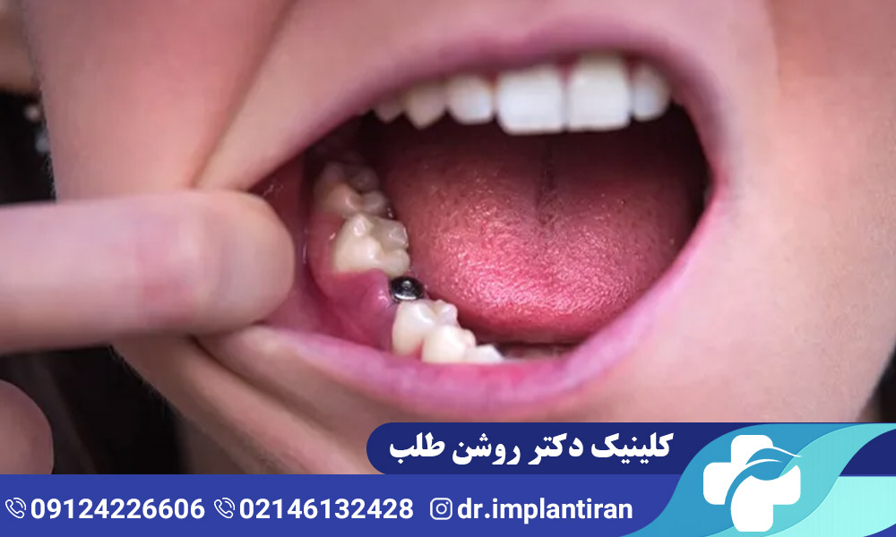درد ایمپلنت دندان