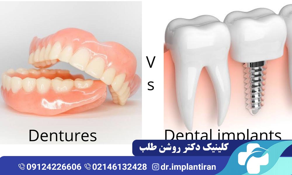تفاوت ایمپلنت با دندان مصنوعی