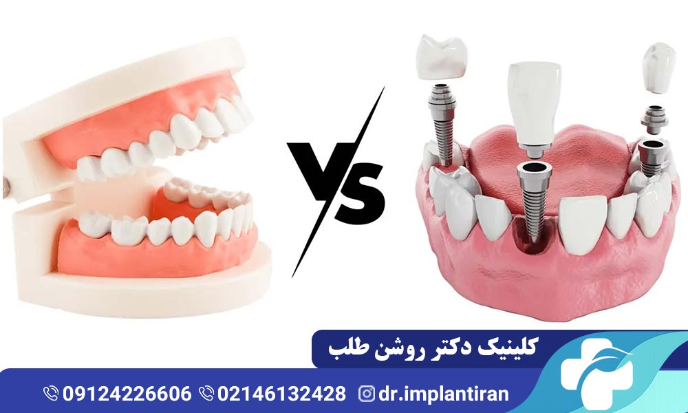 تفاوت ایمپلنت با دندان مصنوعی