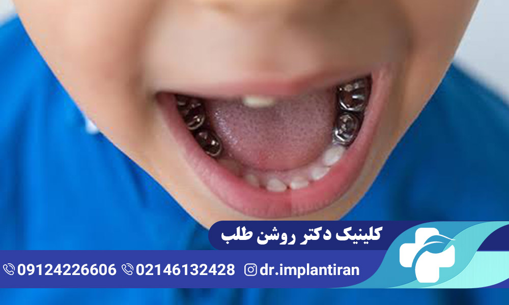 روکش دندان شیری