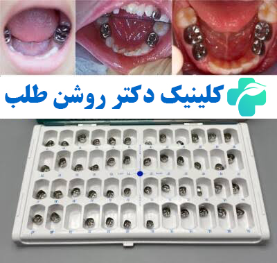 روکش دندان شیری