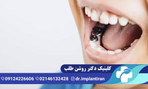روکش دندان شیری