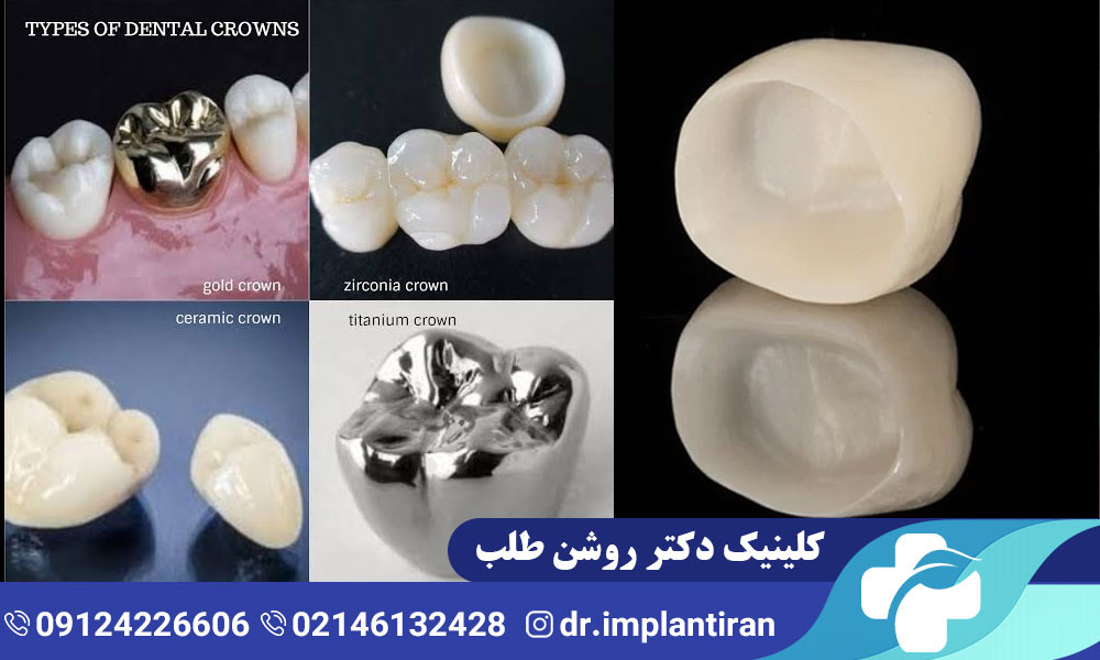 انواع روکش دندان
