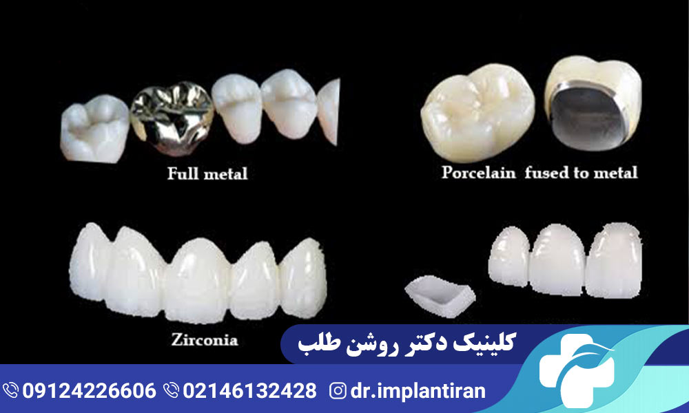 انواع روکش دندان