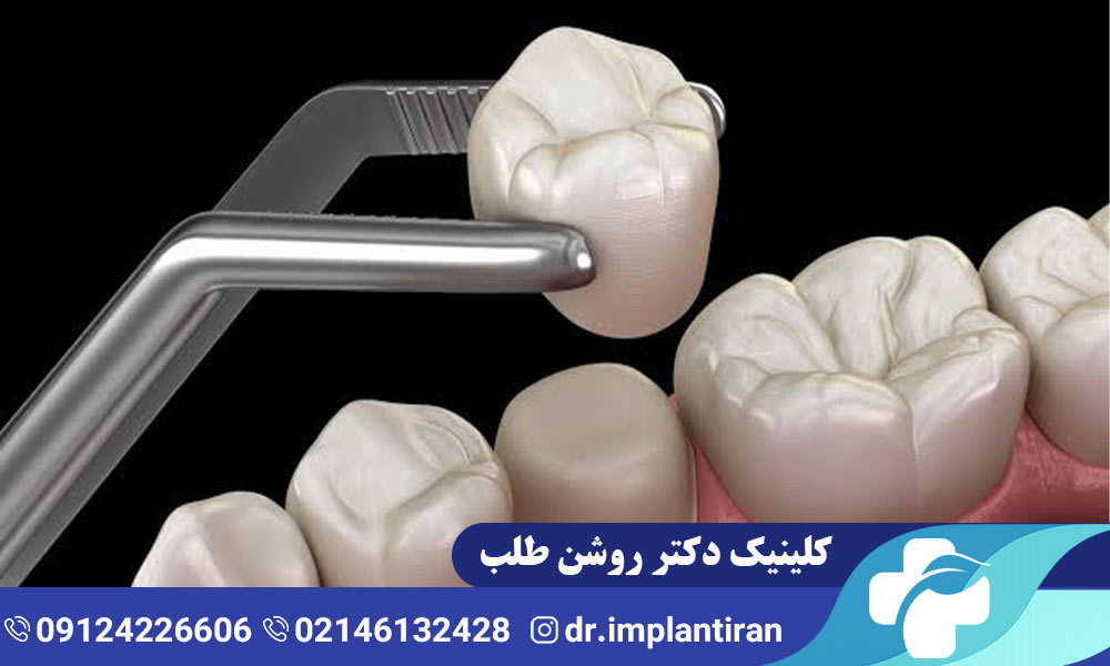 انواع روکش دندان