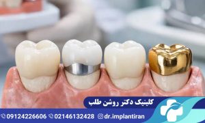 انواع روکش دندان