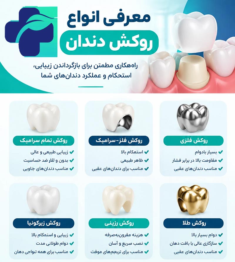 انواع روکش دندان