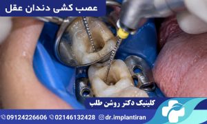 عصب کشی دندان عقل
