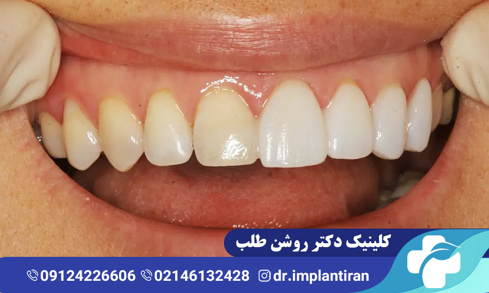 لمینت دندان بدون تراش