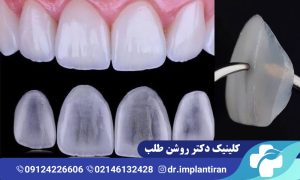 لمینت دندان بدون تراش