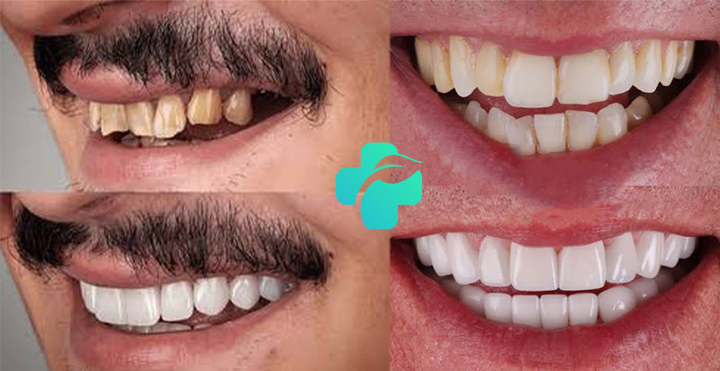 لمینت دندان کج