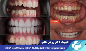 لمینت دندان کج