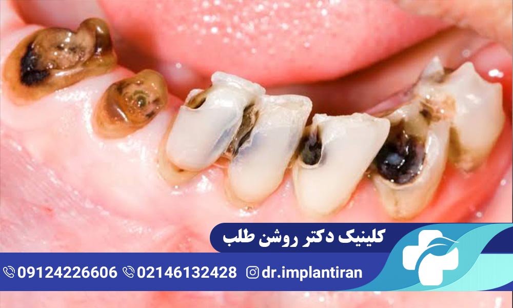 پوسیدگی دندان شیری