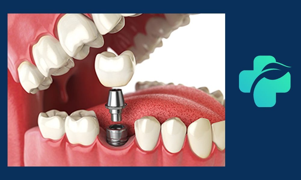ایمپلنت فوری یا یک روزه چیست